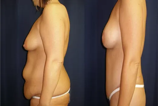 Body Contouring Before & After