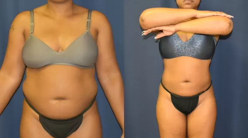 Body Contouring Before & After