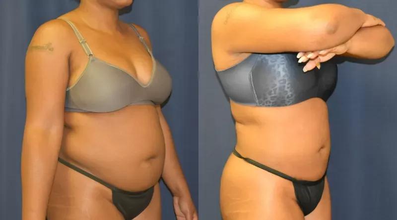 Body Contouring Before & After