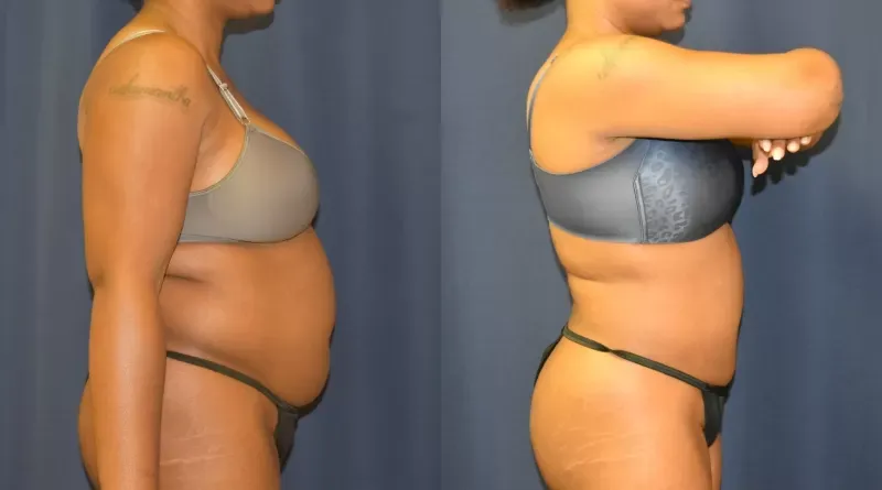 Body Contouring Before & After