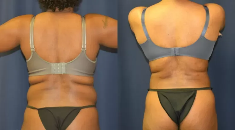 Body Contouring Before & After