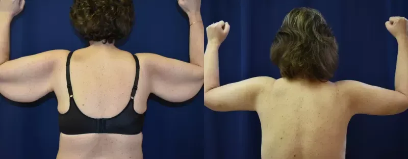 Body Contouring Before & After