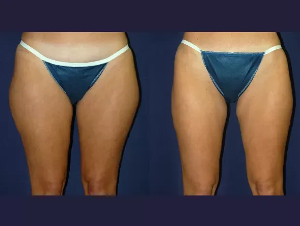 Body Contouring Before & After