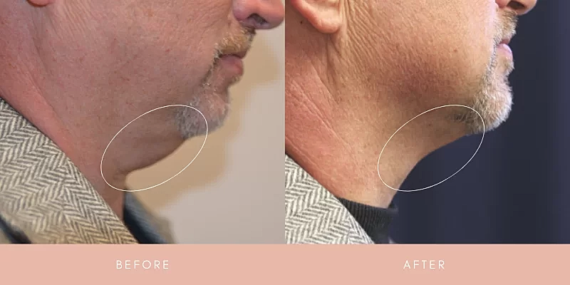 Kybella Before & After