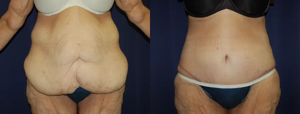Tummy Tuck Before & After