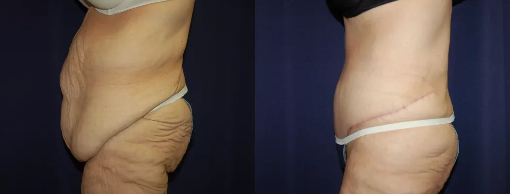 Tummy Tuck Before & After