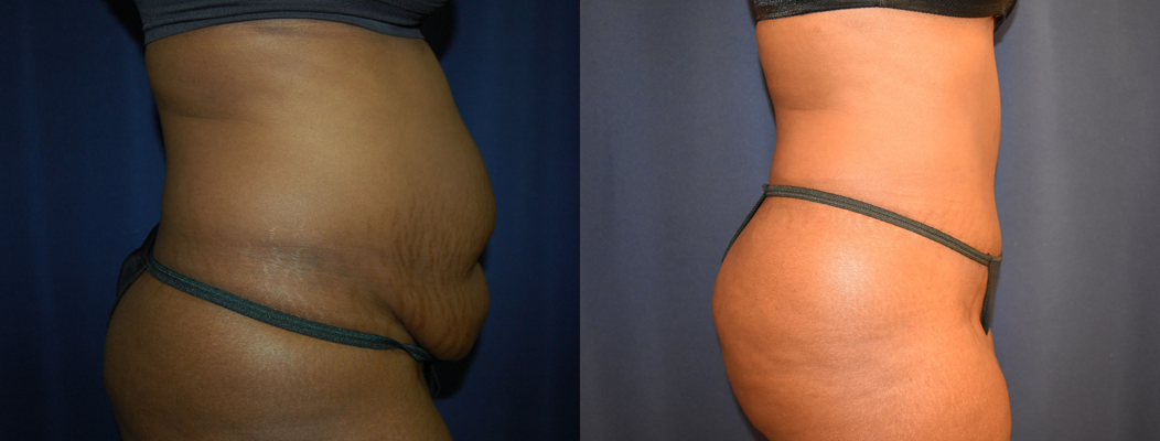 Tummy Tuck Before & After