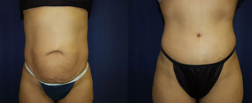 Tummy Tuck Before & After