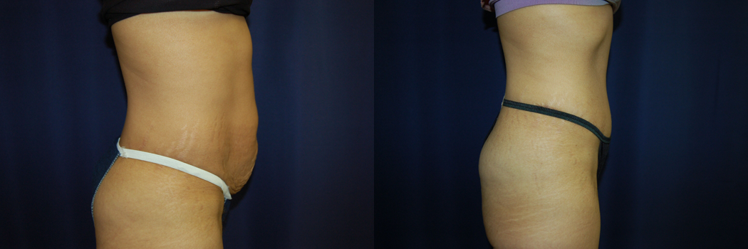 Tummy Tuck Before & After