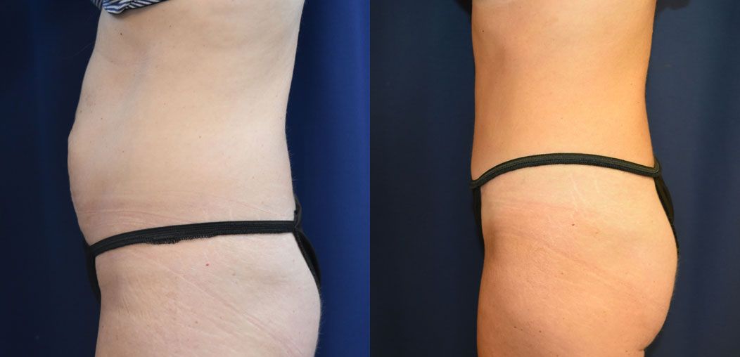 Tummy Tuck Before & After