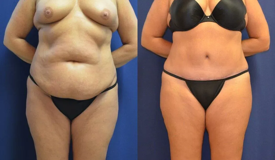 Tummy Tuck Before & After