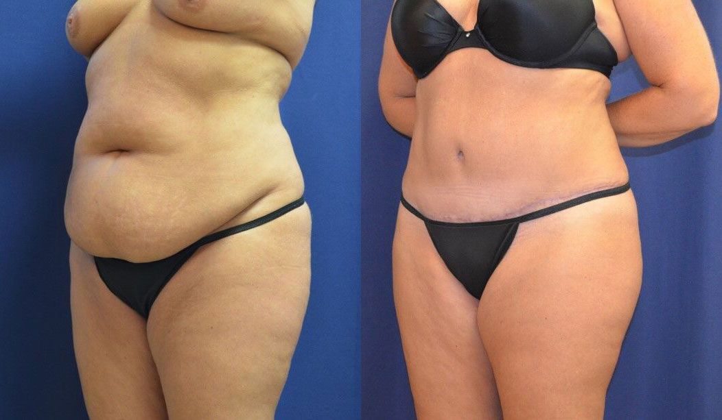 Tummy Tuck Before & After
