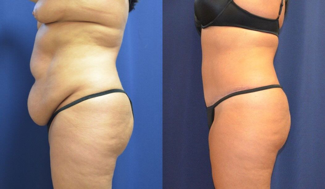 Tummy Tuck Before & After
