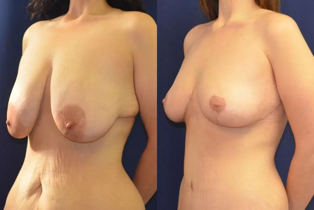 Tummy Tuck Before & After