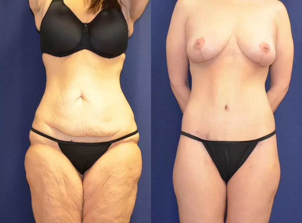 Tummy Tuck Before & After