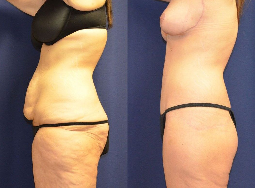 Tummy Tuck Before & After