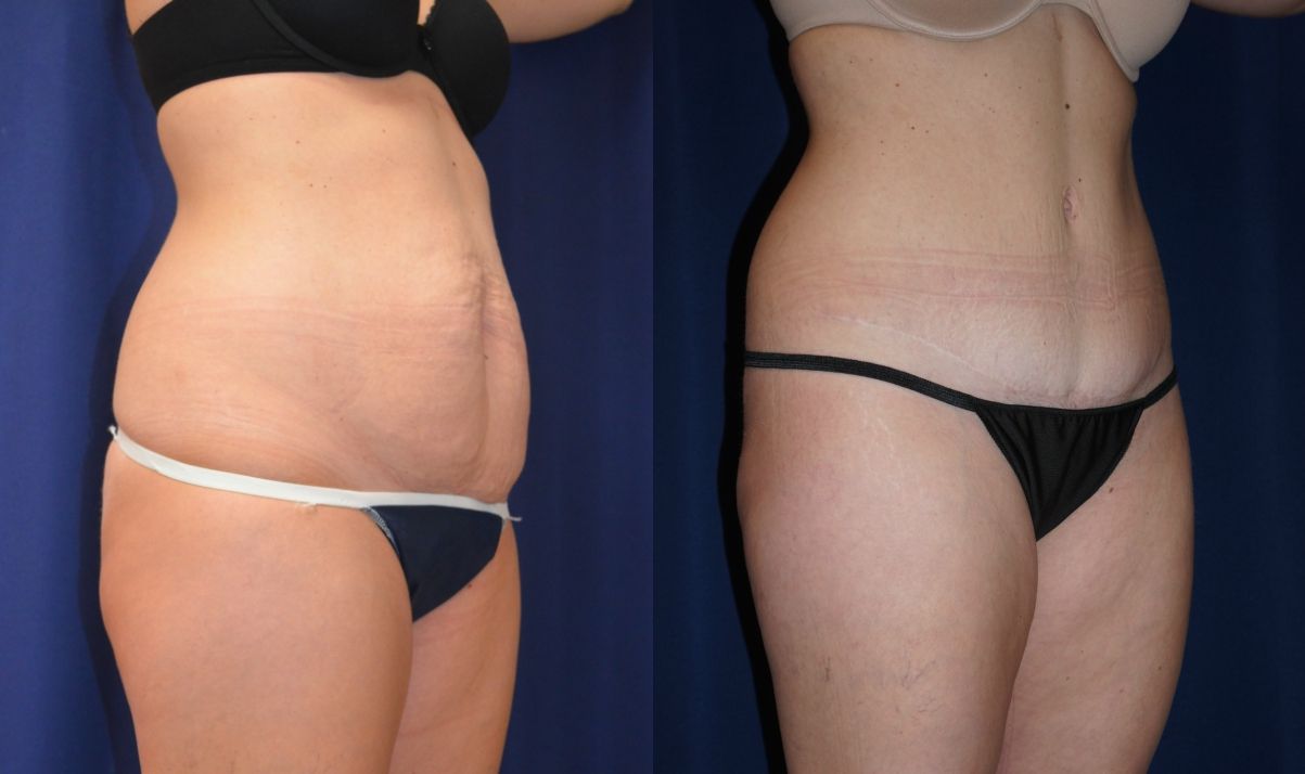 Tummy Tuck Before & After