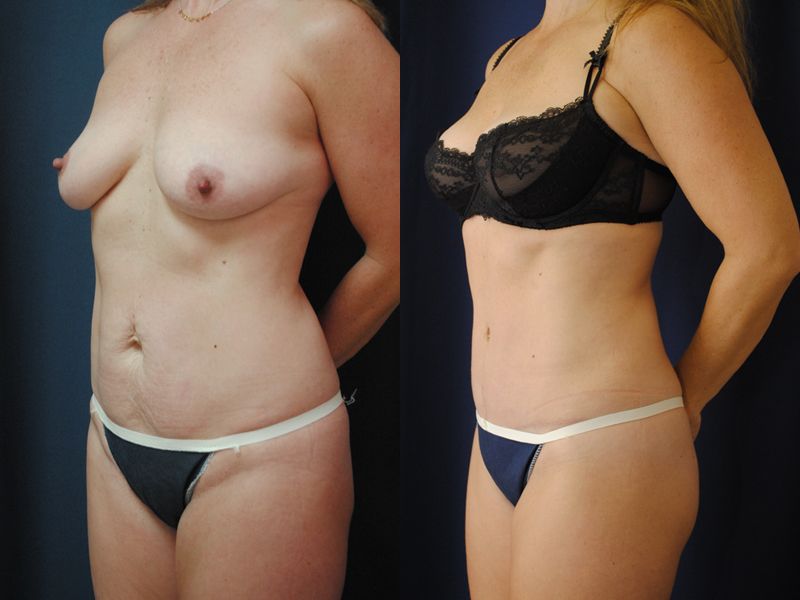 Tummy Tuck Before & After