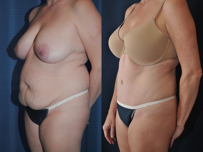 Tummy Tuck Before & After