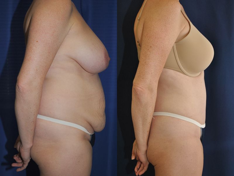 Tummy Tuck Before & After