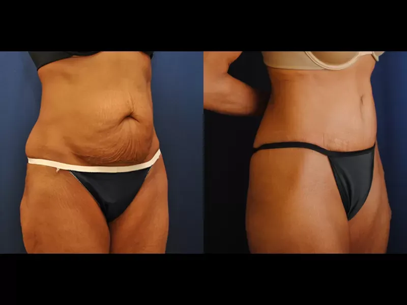 Tummy Tuck Before & After