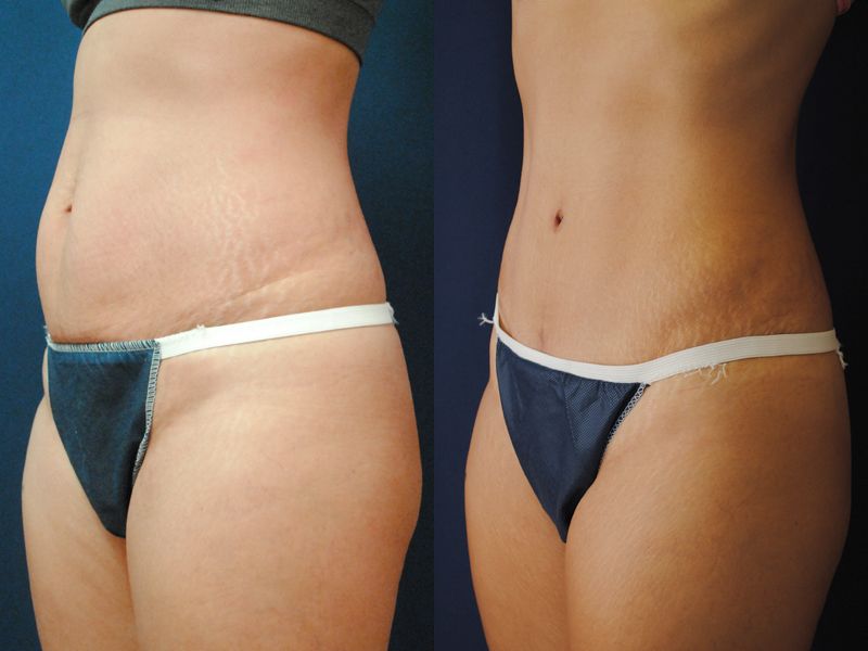 Tummy Tuck Before & After