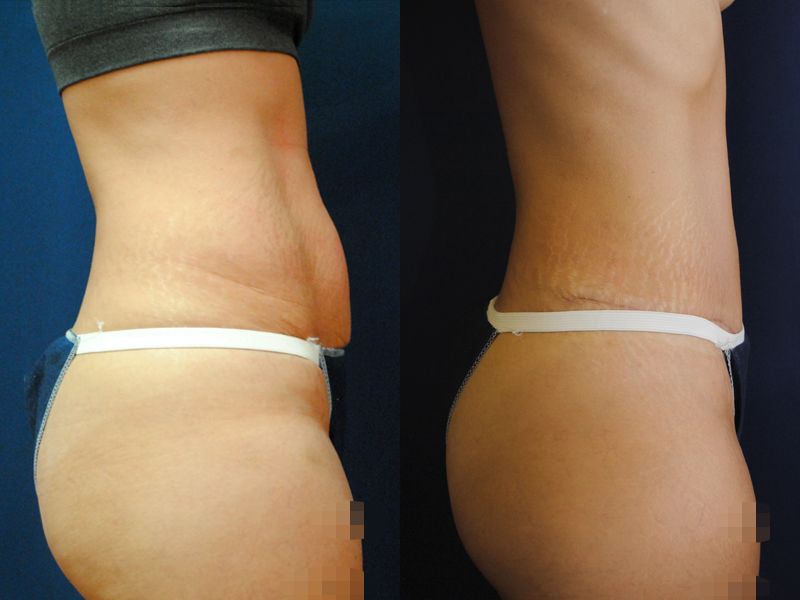 Tummy Tuck Before & After