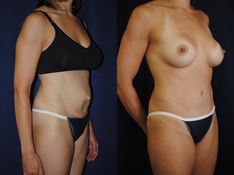 Tummy Tuck Before & After