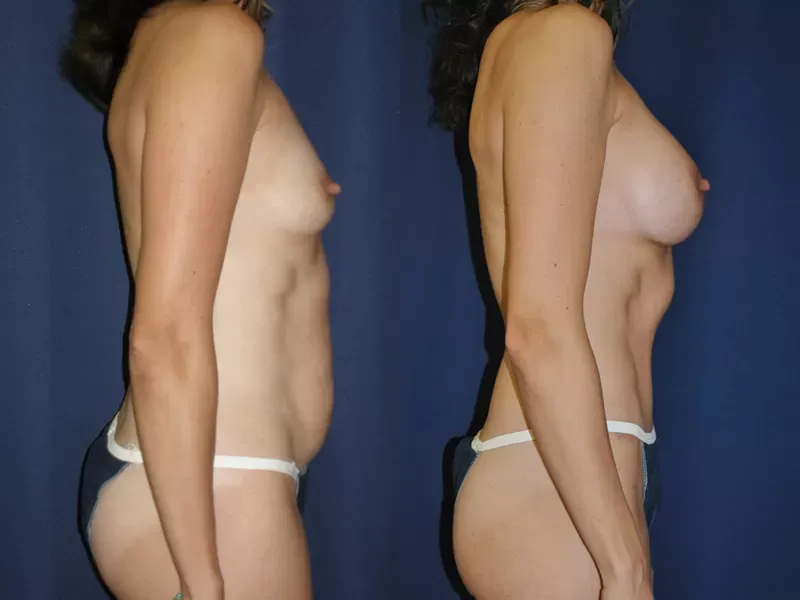 Tummy Tuck Before & After