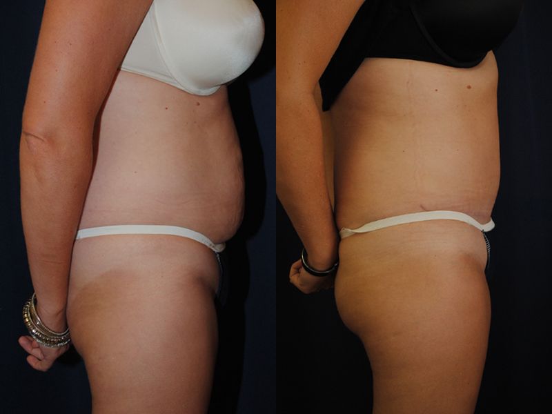 Tummy Tuck Before & After