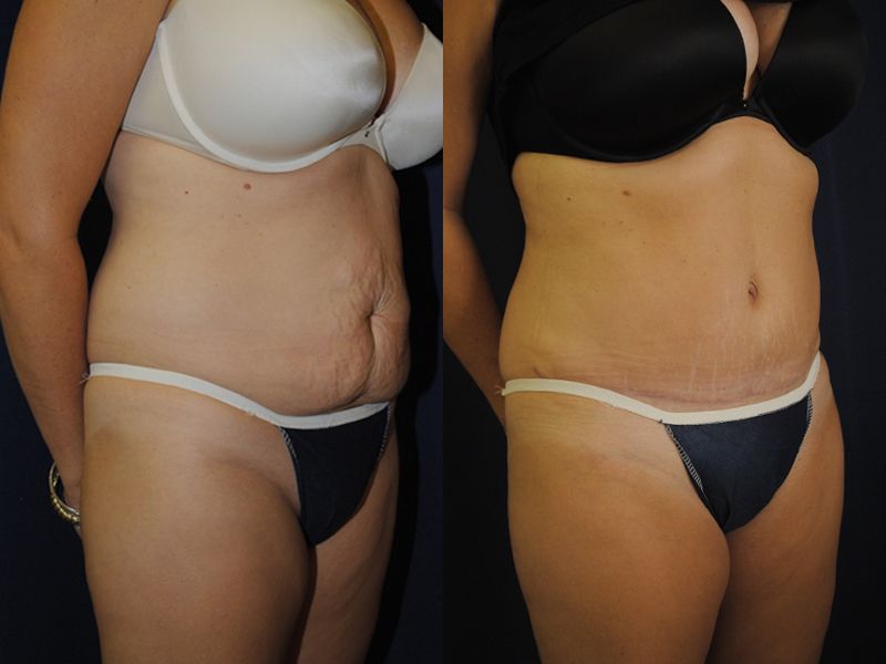 Tummy Tuck Before & After