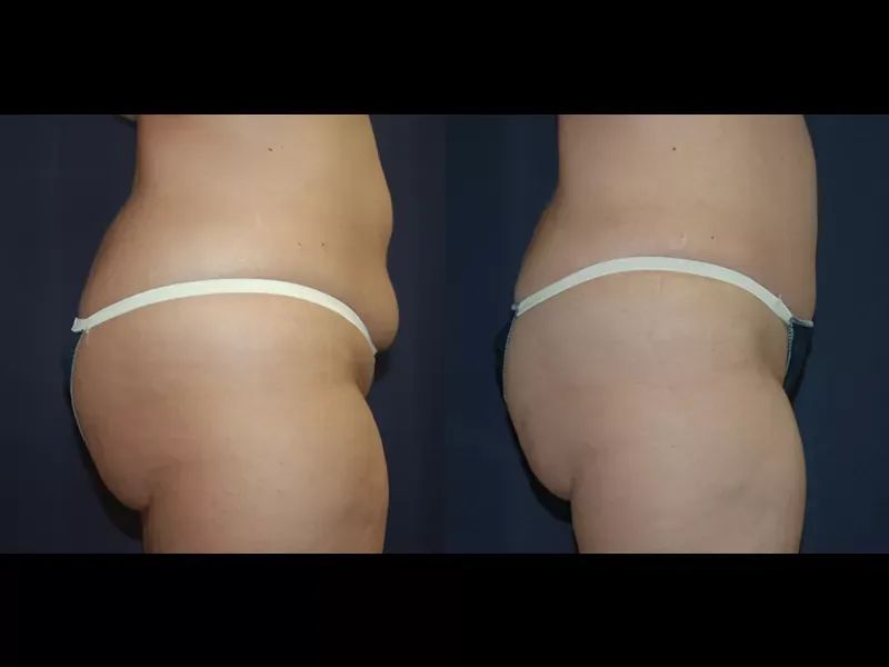 Tummy Tuck Before & After