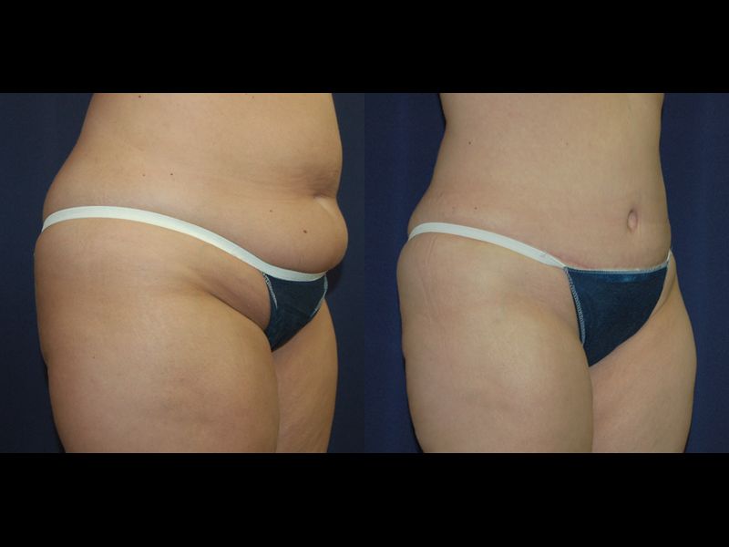 Tummy Tuck Before & After