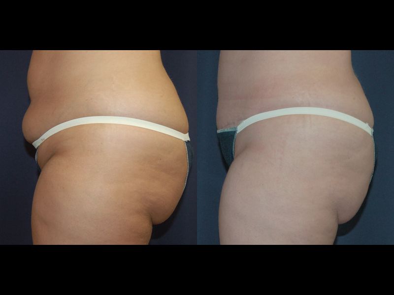 Tummy Tuck Before & After