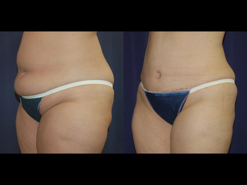Tummy Tuck Before & After