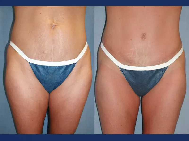 Tummy Tuck Before & After