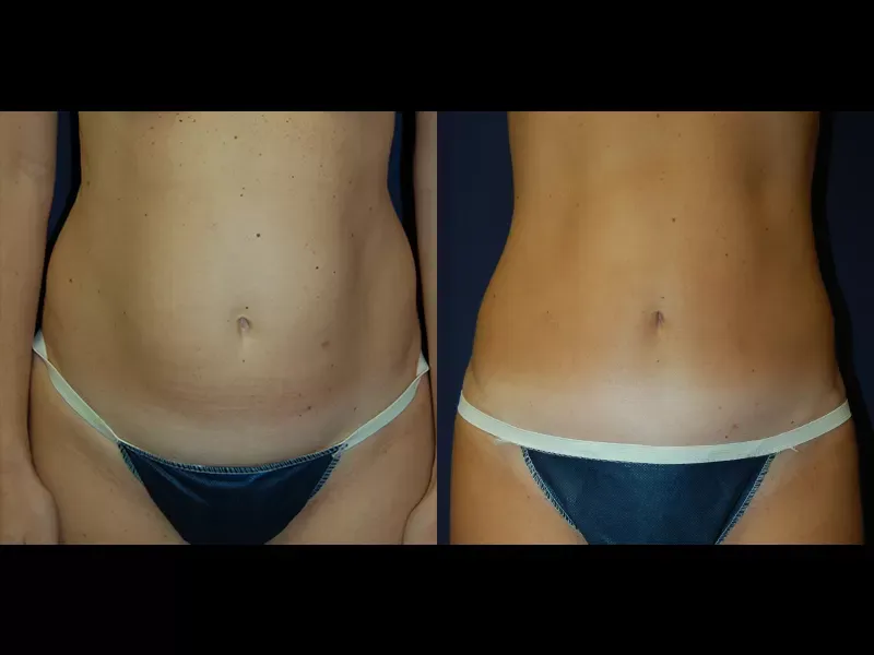 Tummy Tuck Before & After