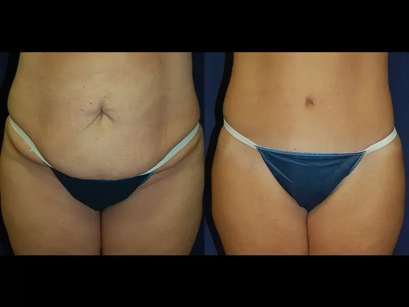 Tummy Tuck Before & After