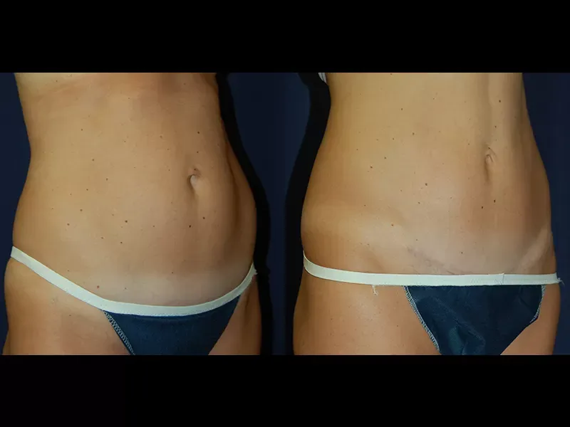 Tummy Tuck Before & After