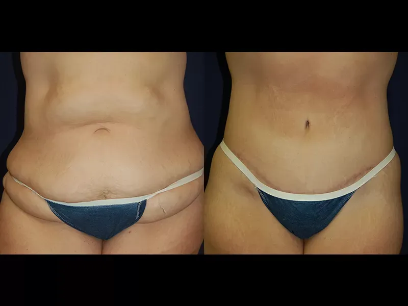 Tummy Tuck Before & After