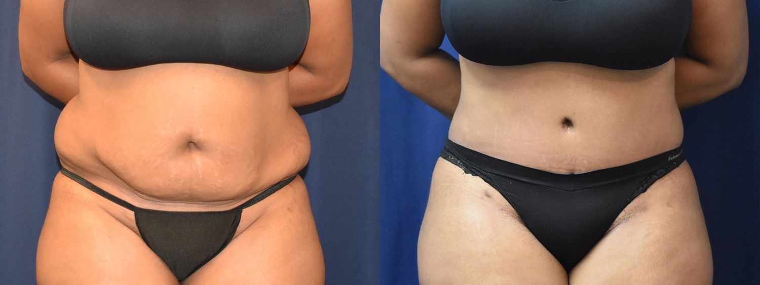 Tummy Tuck Before & After