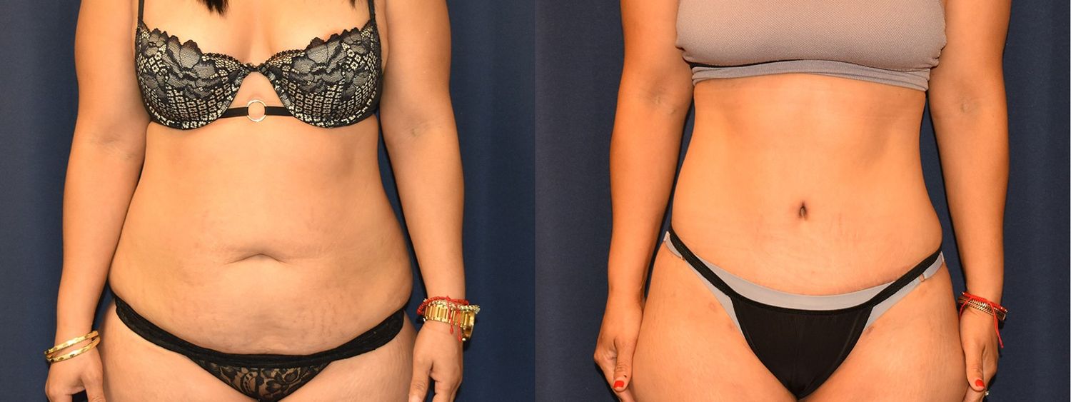 Tummy Tuck Before & After