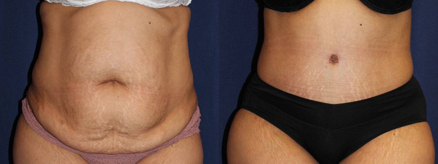 Tummy Tuck Before & After