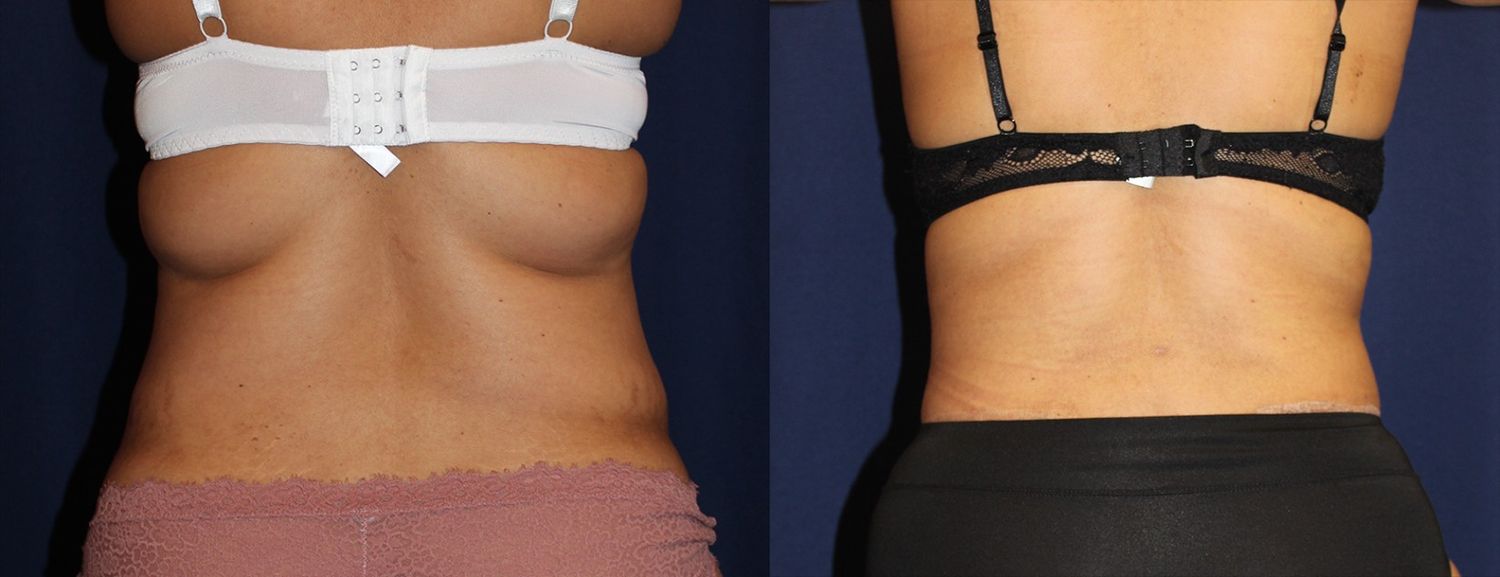 Tummy Tuck Before & After