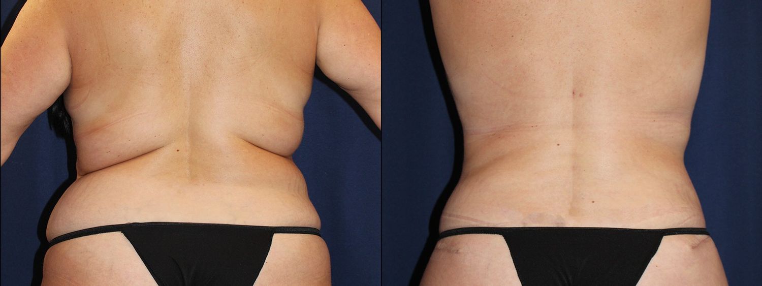 Tummy Tuck Before & After