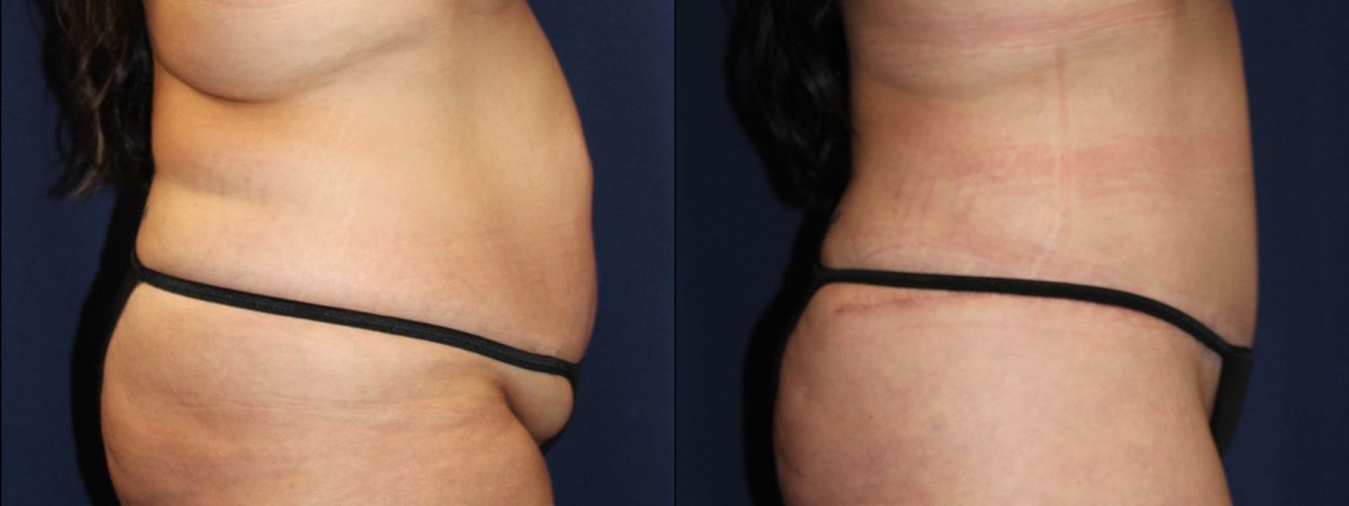 Tummy Tuck Before & After