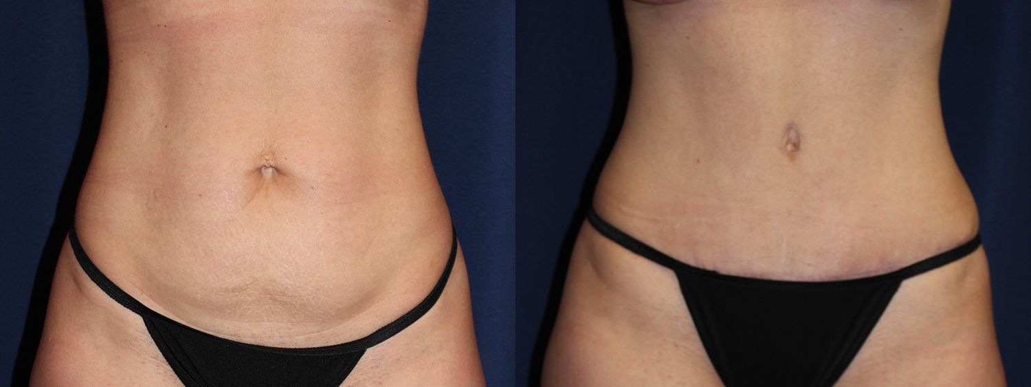 Tummy Tuck Before & After