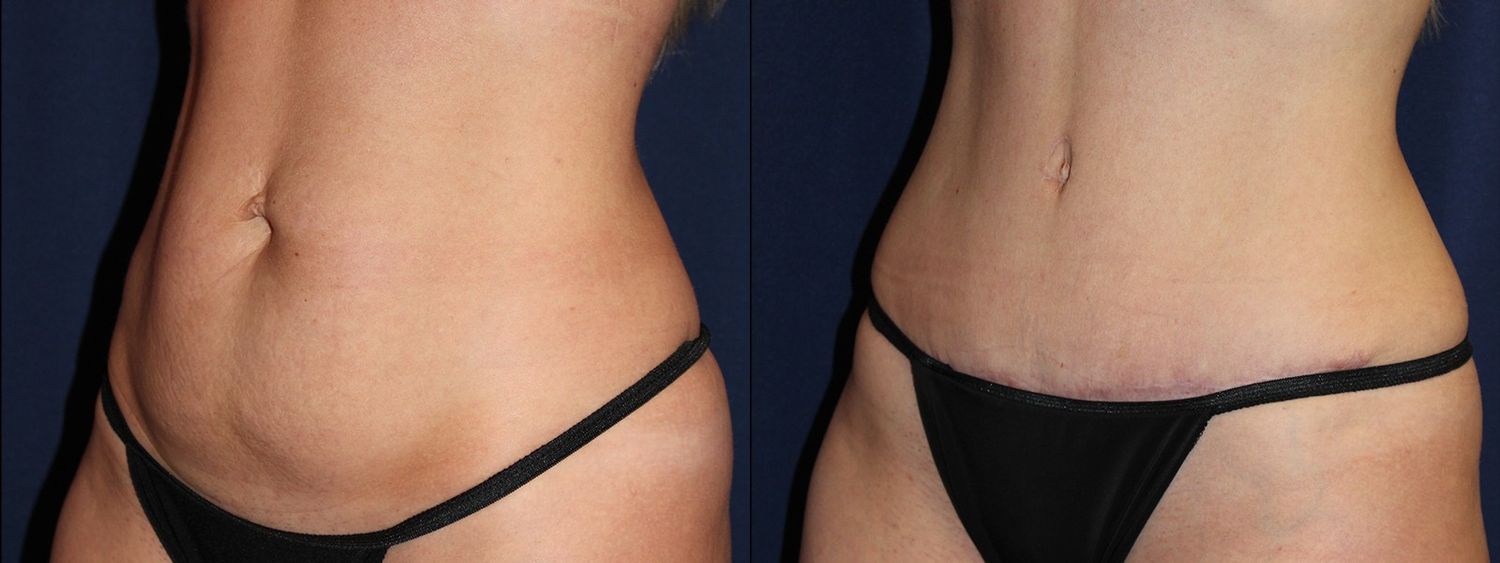 Tummy Tuck Before & After