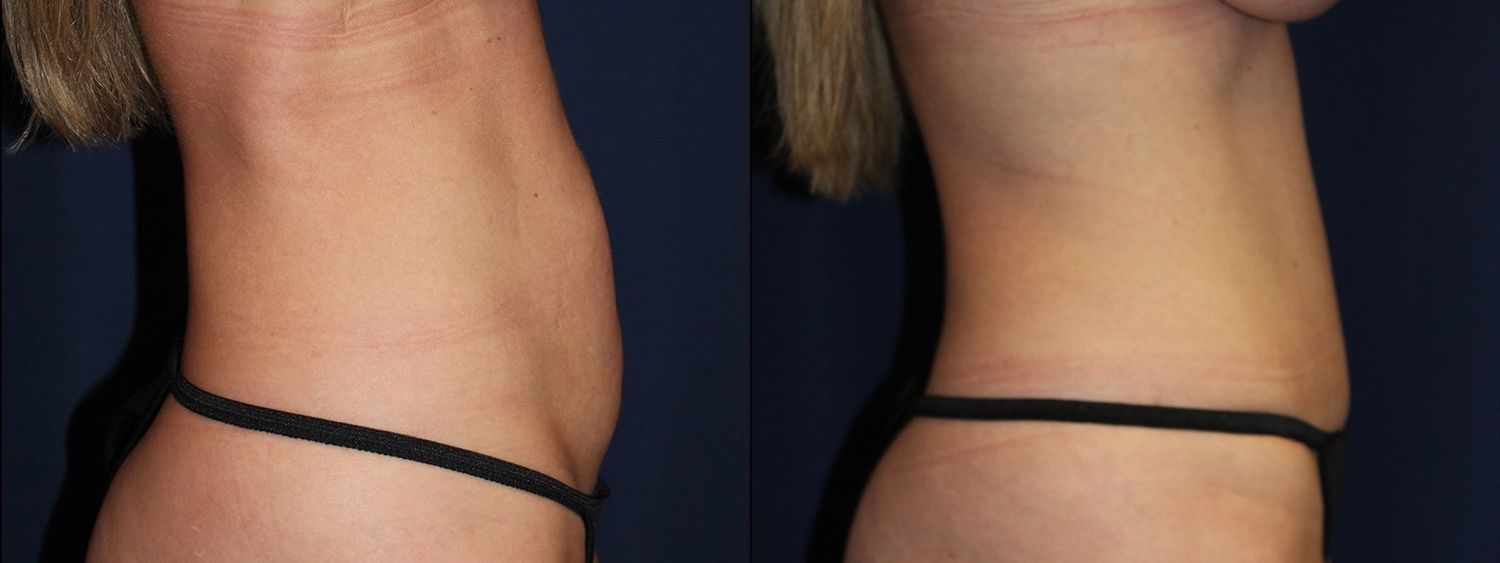 Tummy Tuck Before & After