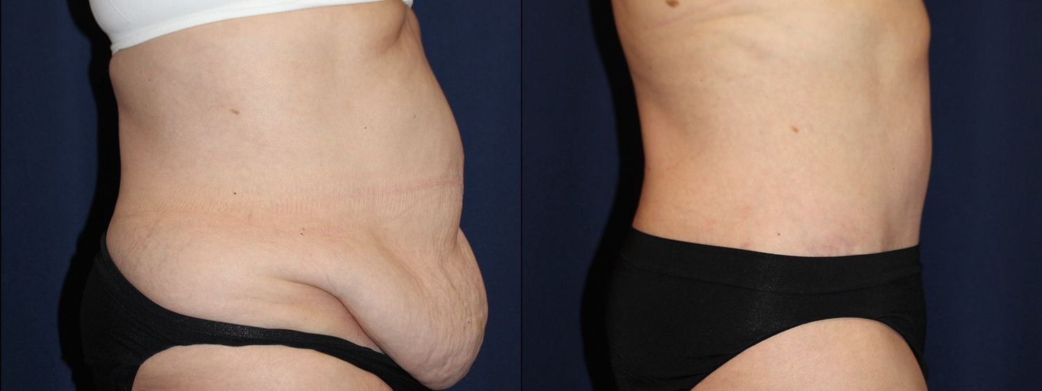 Tummy Tuck Before & After